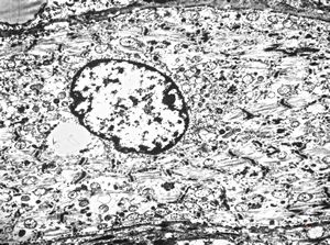 M,31y. | rhabdomyoblasts - tumor? - regeneration? - lip M,31y. | rhabdomyoblasts - tumor? - regeneration? - lip